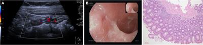 Case Report: IBD-like colitis following CAR T cell therapy for diffuse large B cell lymphoma